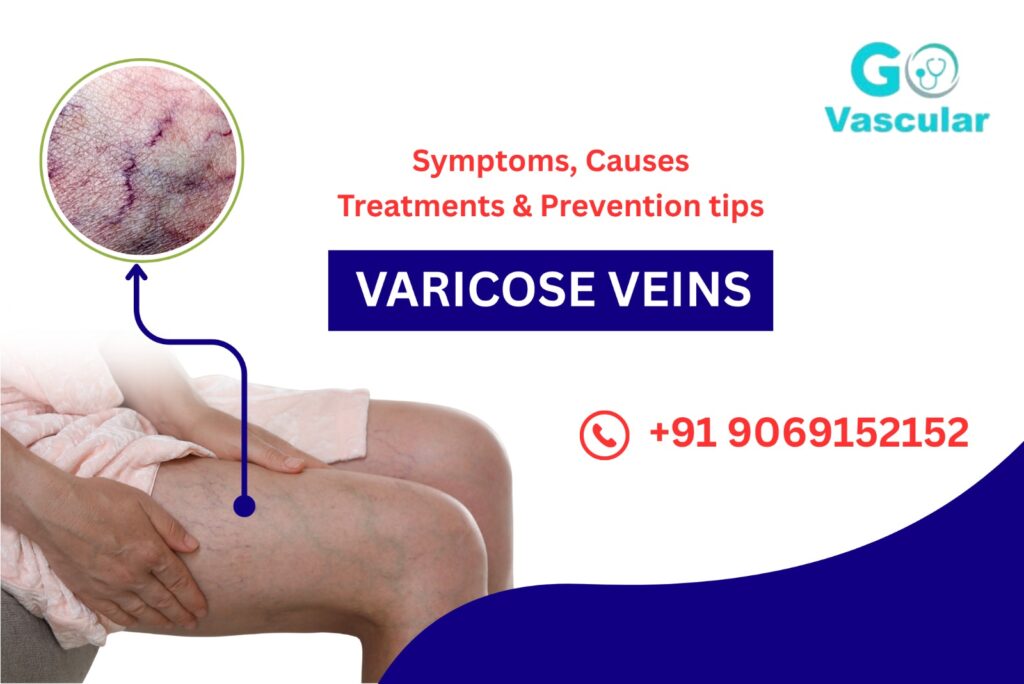 Varicose Veins